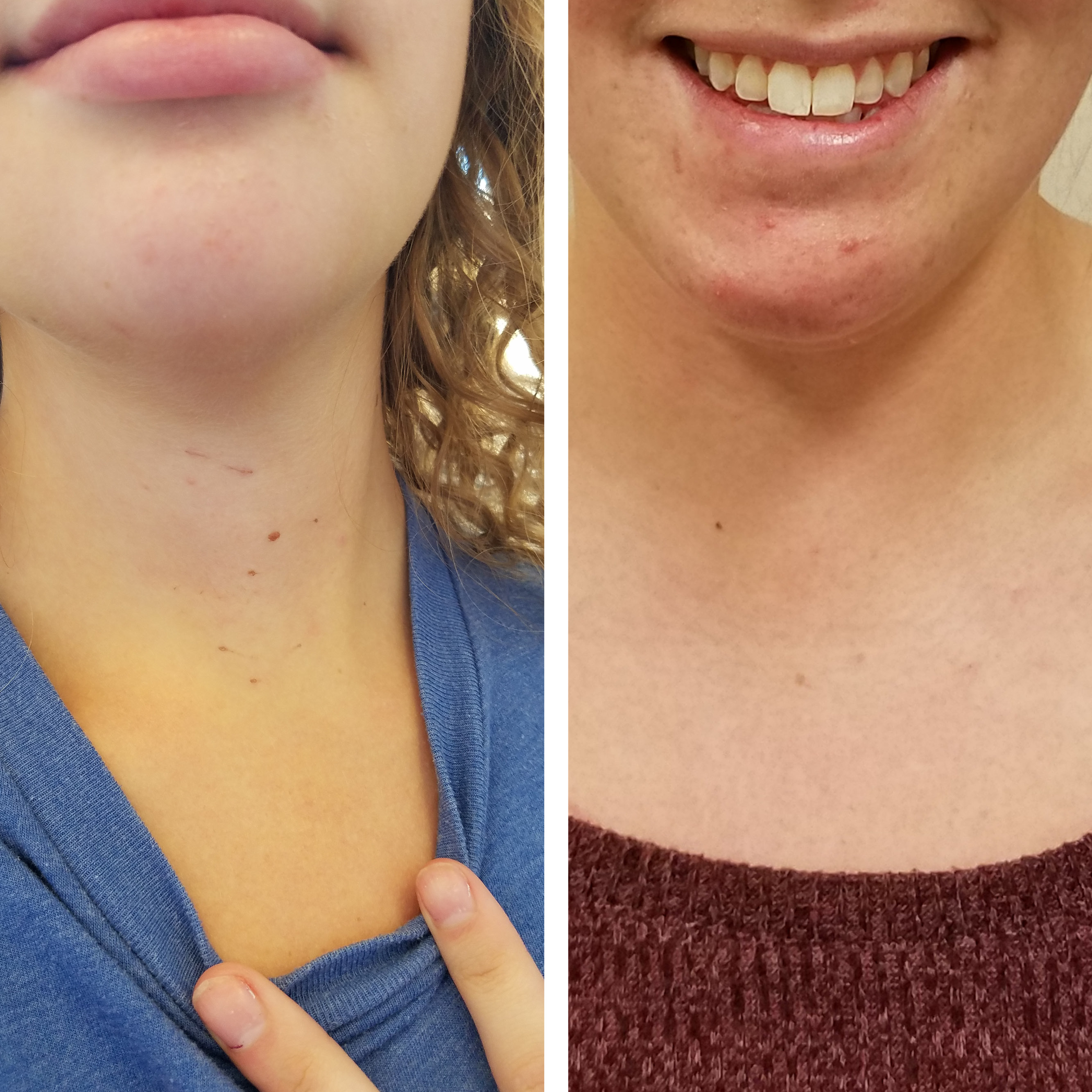 completely-scarless-thyroidectomies